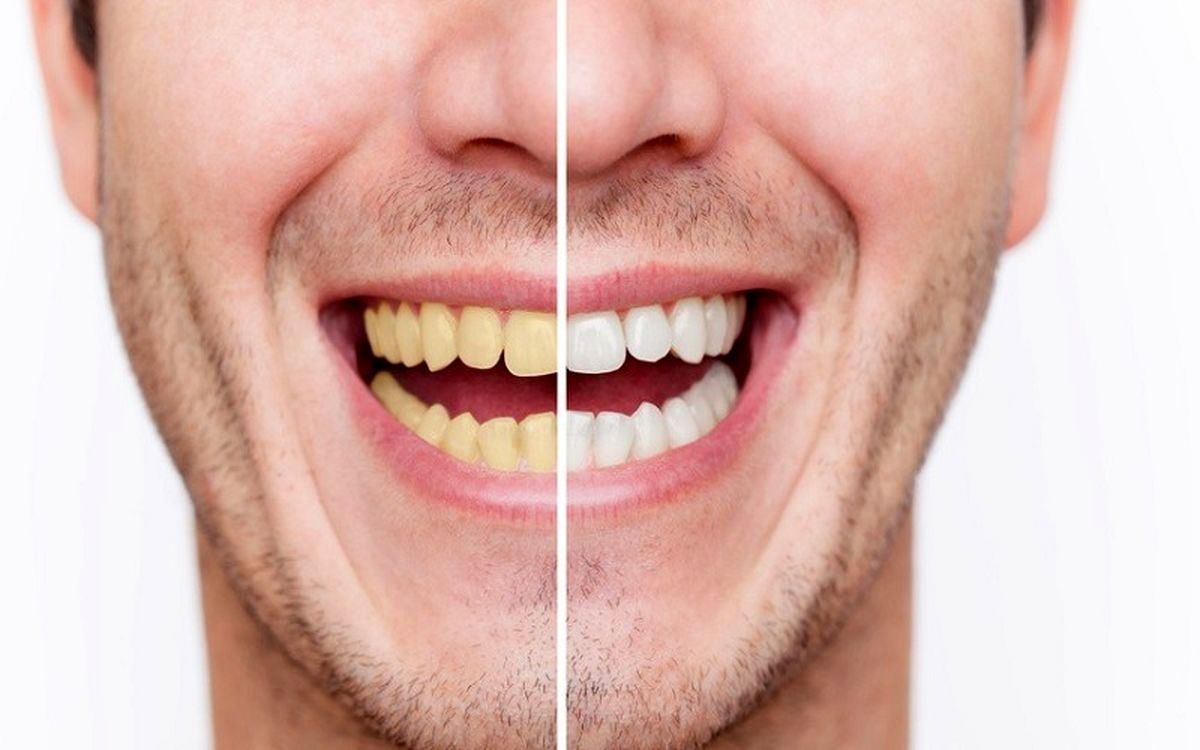 راهکارهایی برای خلاصی از زردی دندان‌ها