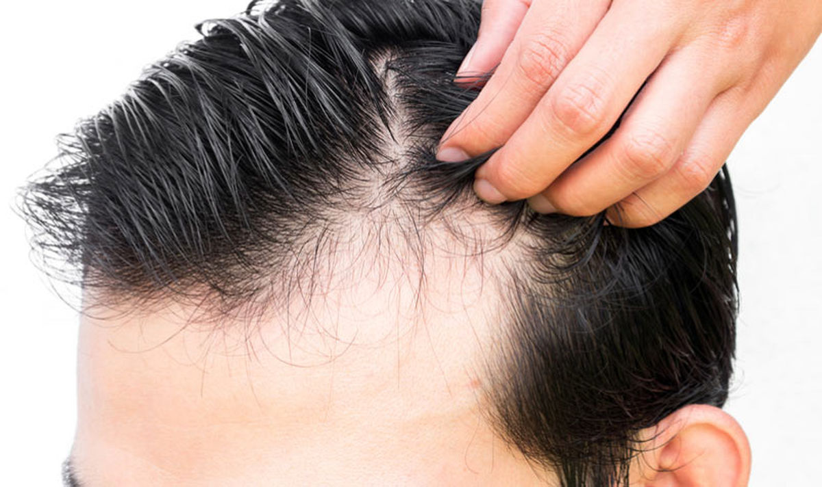 ریزش مو پس از کرونا درمان دارد ؟