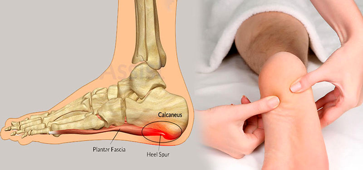 خار پاشنه چیست ؟ + راه‌های درمان