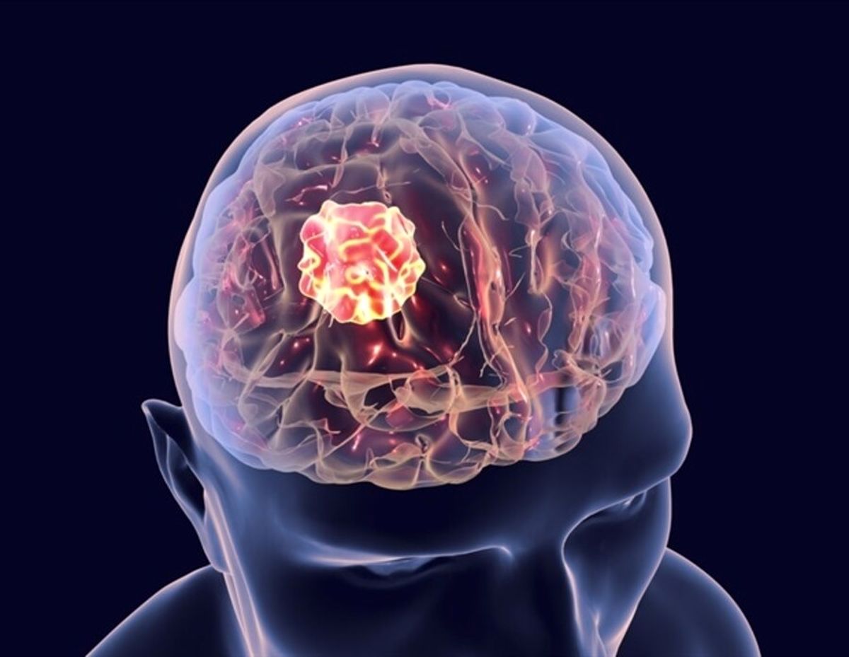 علام تومور مغزی و راه‌های درمان