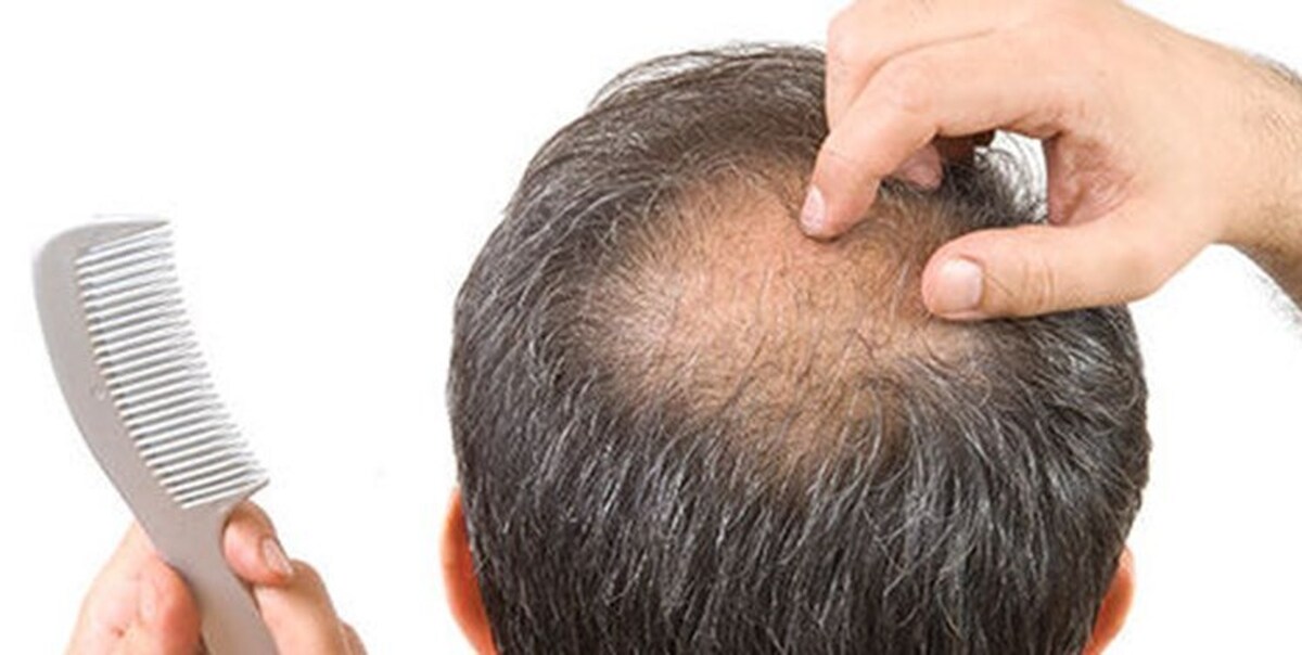 درمان ریزش مو با این ترفند خیلی ساده