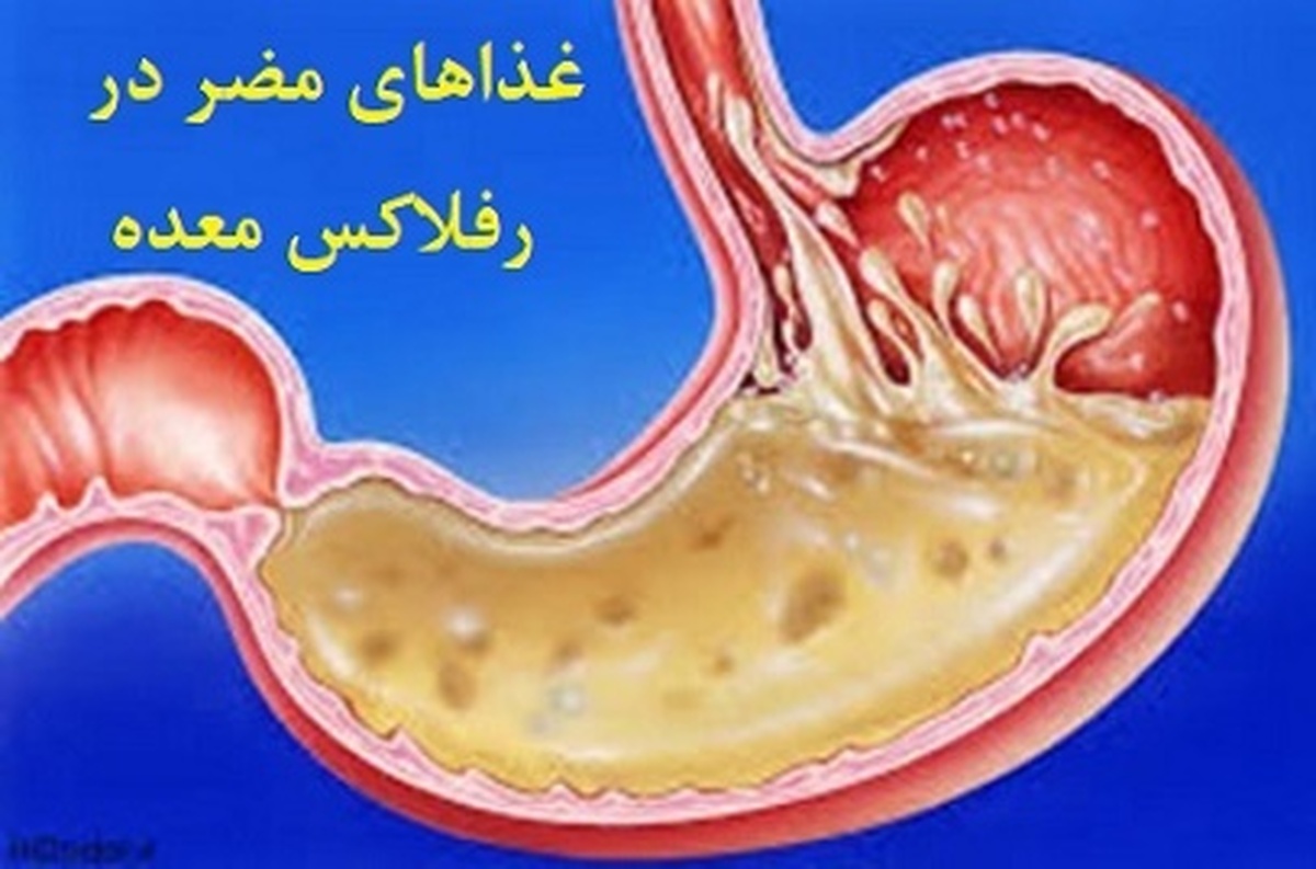 ۷ ماده غذایی مفید برای افرادی که رفلاکس معده دارند