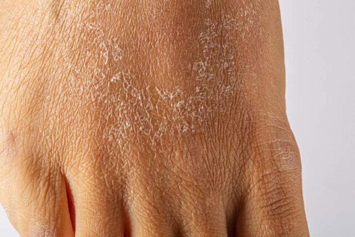 با این ۵ کار از خشکی پوست در زمستان جلوگیری کنید