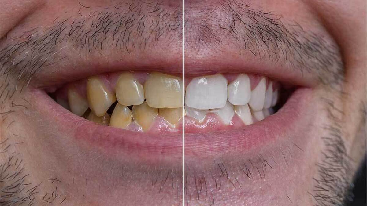 ساده ترین روش‌ ها برای سفید کردن دندان در خانه