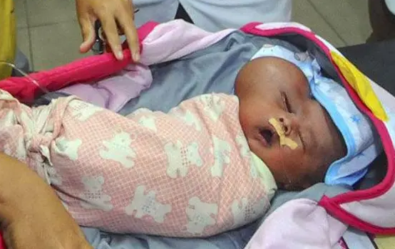 عکس | تولد یک نوازد با سری عجیب و غریب