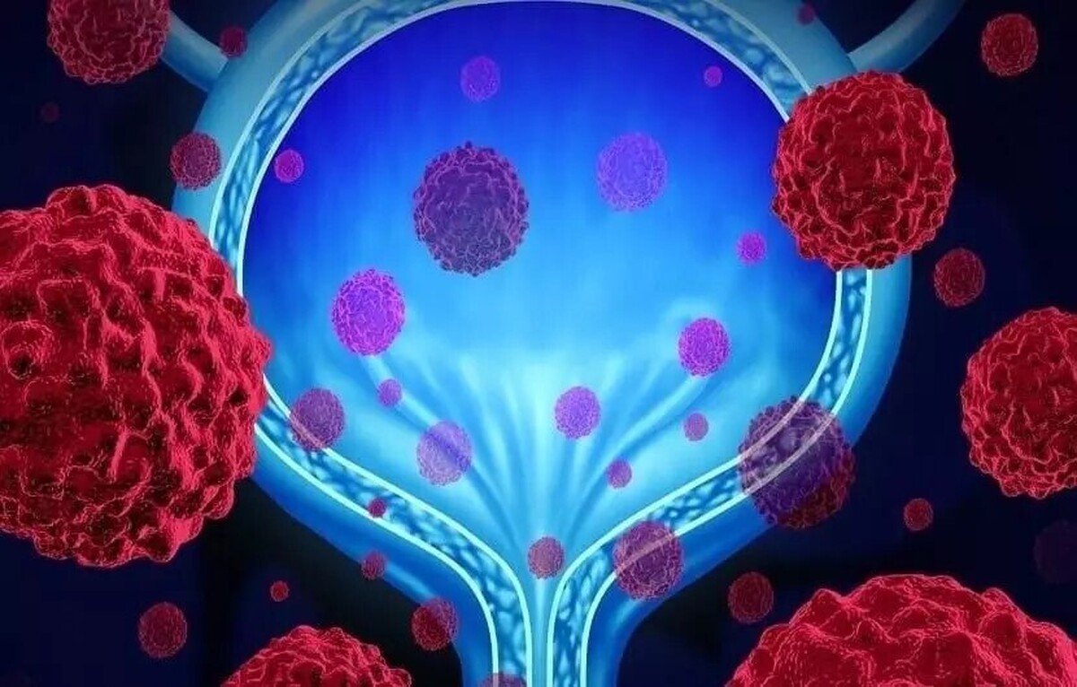 مردان ایرانی بیشتر به این سرطان مبتلا می‌شوند