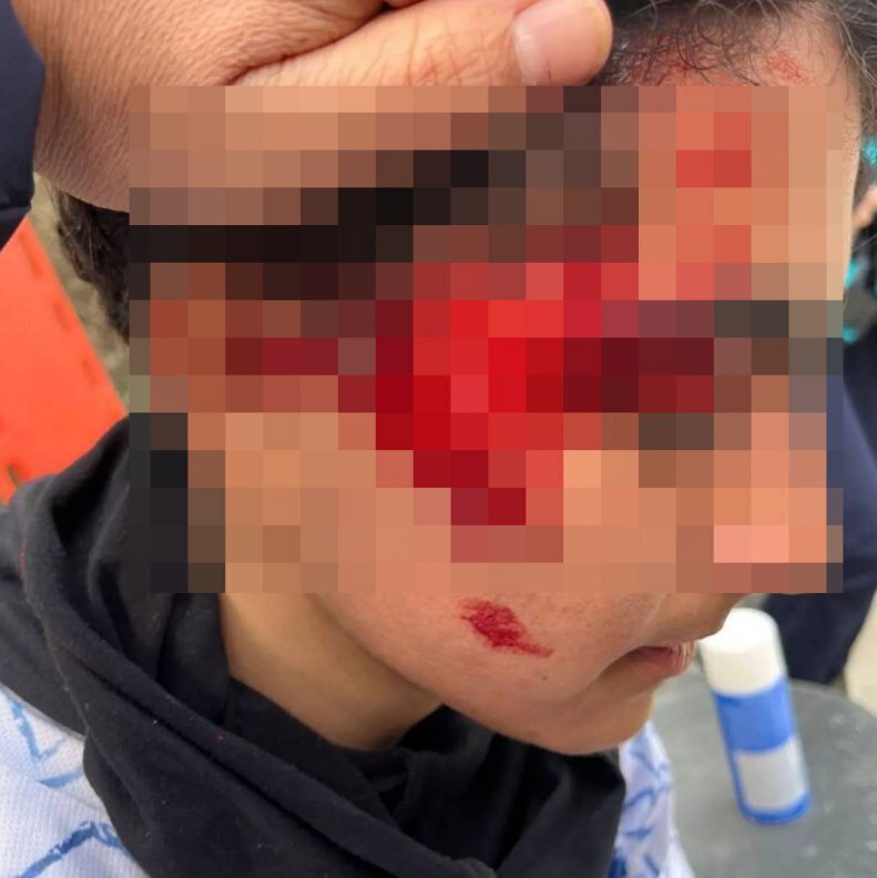 عکس | فوتبال زنان ایران بوی «خون» | گرفت سه بازیکن روانه بیمارستان شدند