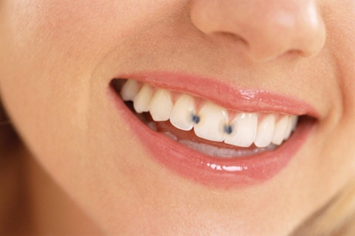 کشف جدید | این مایع ارزان‌قیمت از پوسیدگی دندان جلوگیری می‌کند