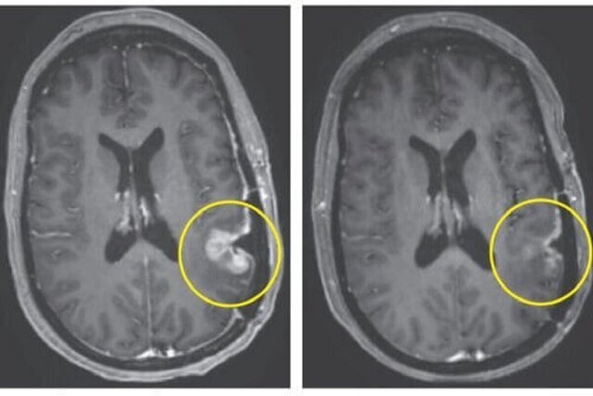 کشف یک روش درمان تومور‌های کشنده مغز تنها ۵ روز