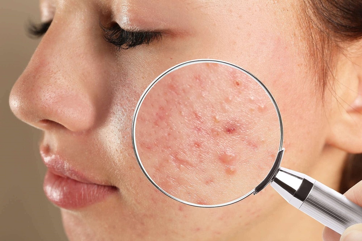 چگونه از شر جوش‌ها و آکنه خلاص شویم ؟