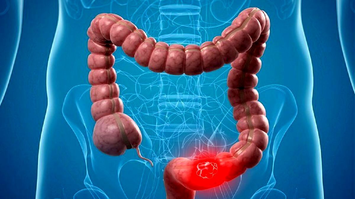 این نشانه‌ها می‌گویند که سرطان روده دارید