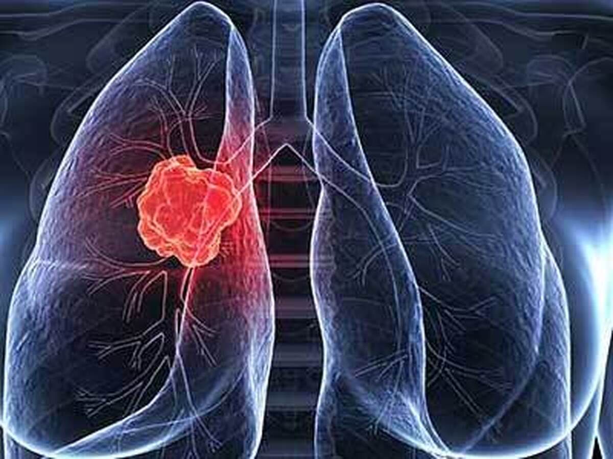 شایع‌ترین علائم سرطان ریه را بشناسید