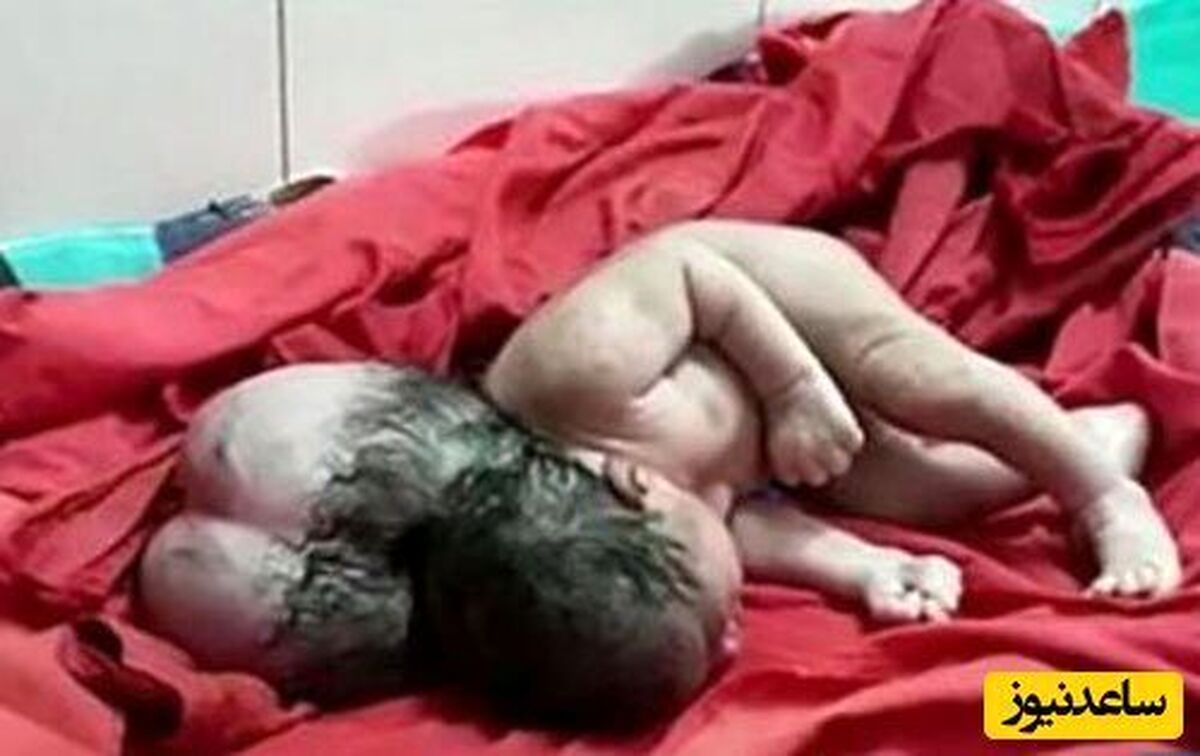 اتفاق عجیب در هند | یک نوزاد با سه سر به دنیا آمد + عکس