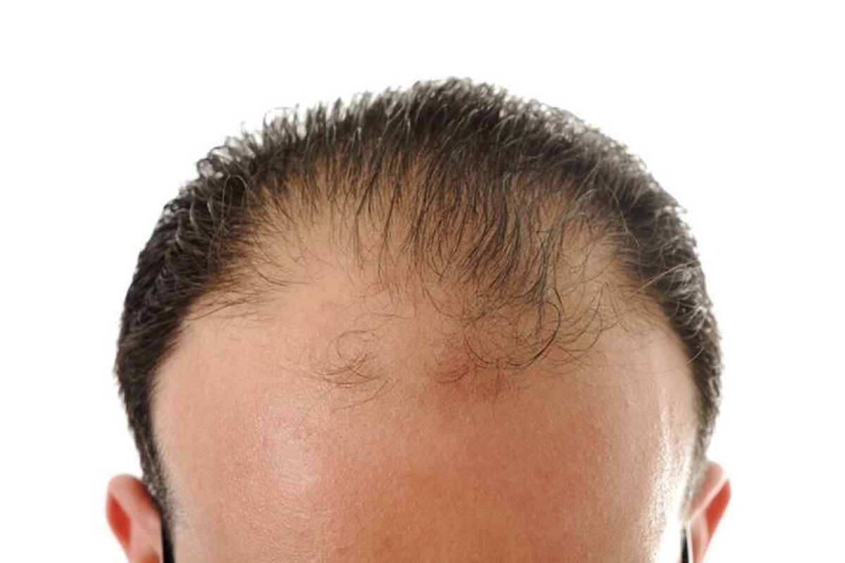 مهم‌ترین علت ریزش مو در مردان و زنان
