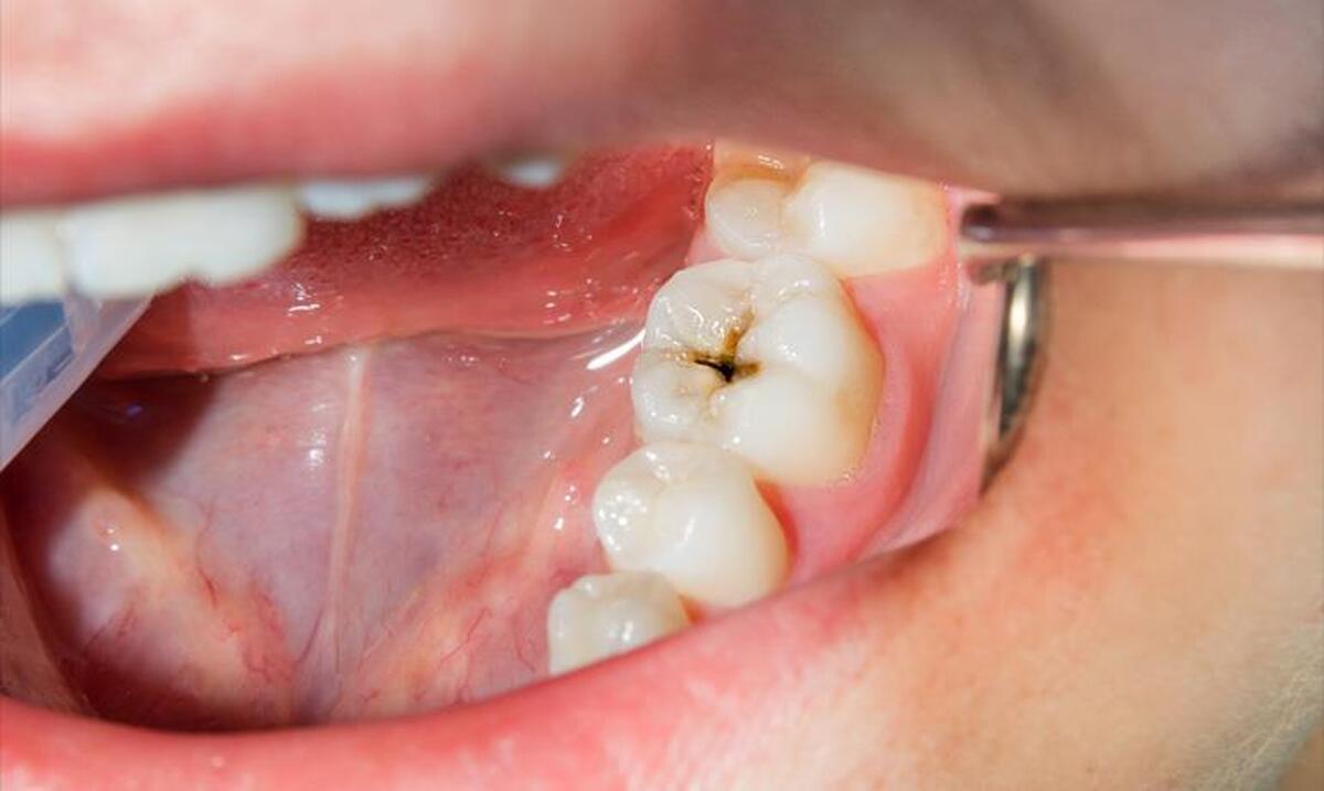 پوسیدگی دندان با نخوردن این ویتامین‌ها