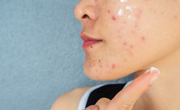 کرم ضد جوش پوست چرب قاتل جوش های پوست صورت