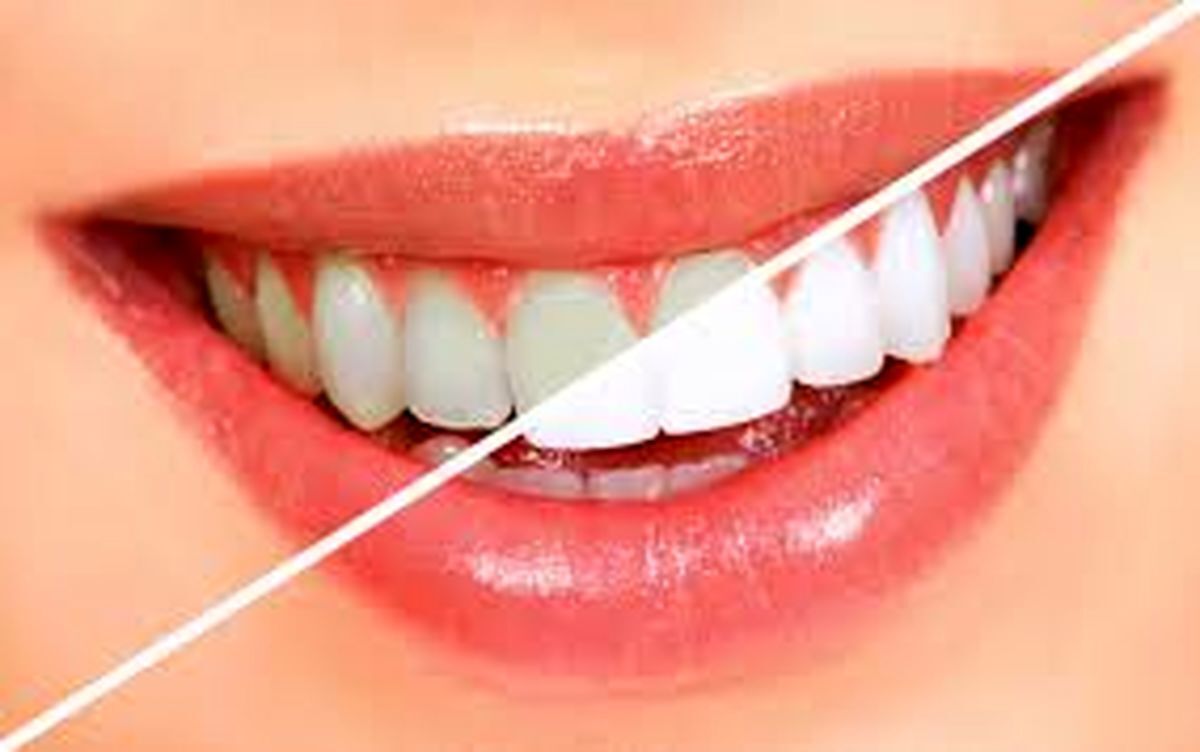 دندانتان را با حذف این عادت‌ها سفید نگه دارید 