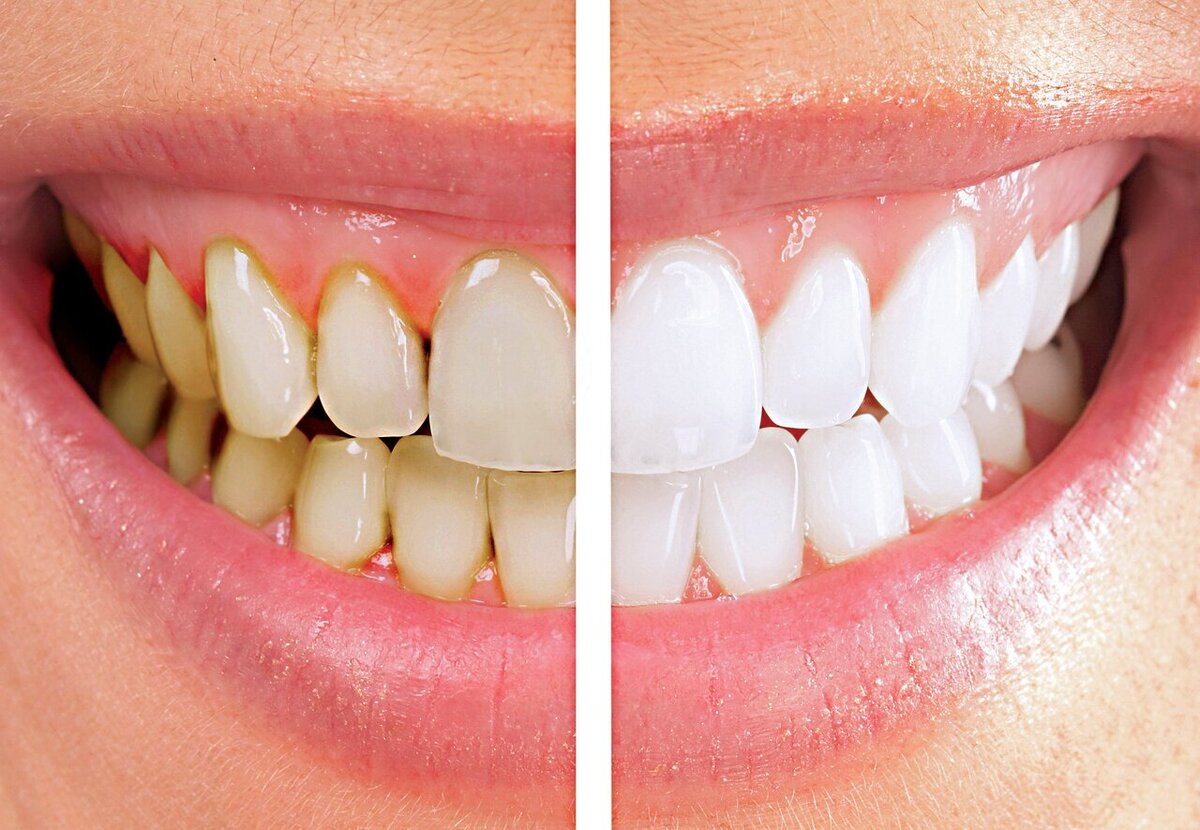 چه عواملی موجب زرد شدن دندان‌‌‌‌‏ ها می‌‌‌‌‏شوند