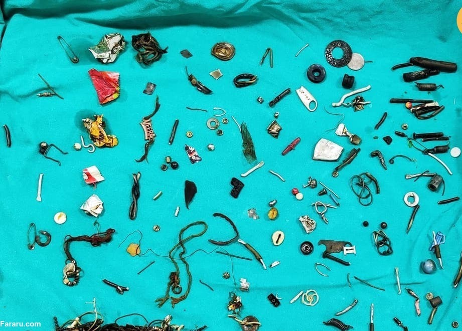 عکس | مردی که دستبند و گوشی و ۱۵۰شیء دیگر را خورده بود