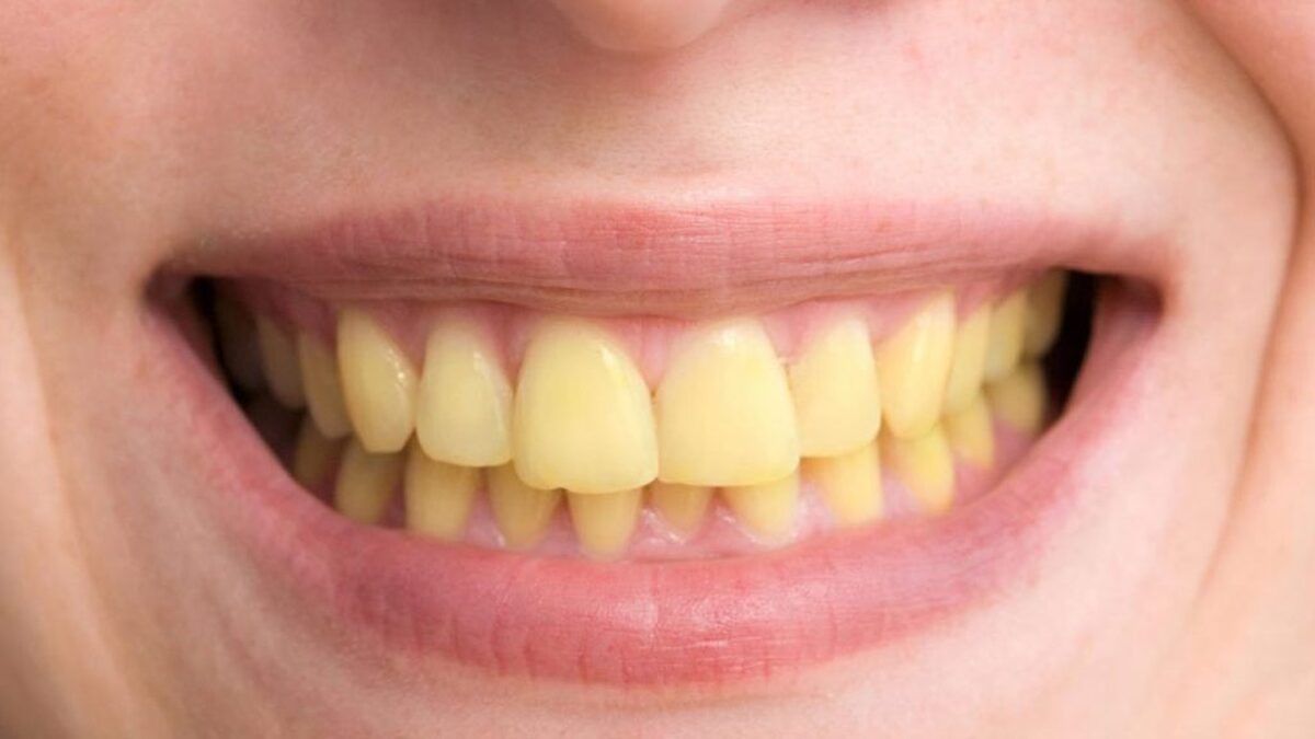 این عادت‌های اشتباه باعث زردی دندان‌ها می‌شود