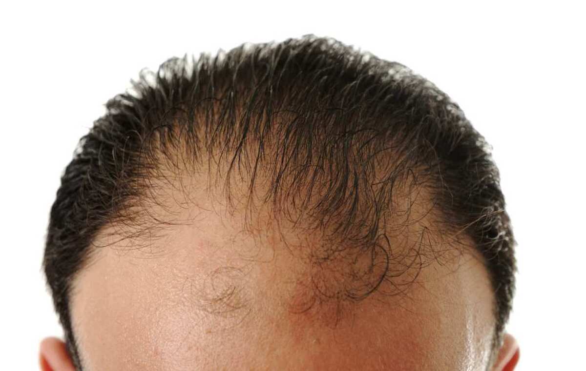 علت اصلی ریزش موی مردان کشف شد