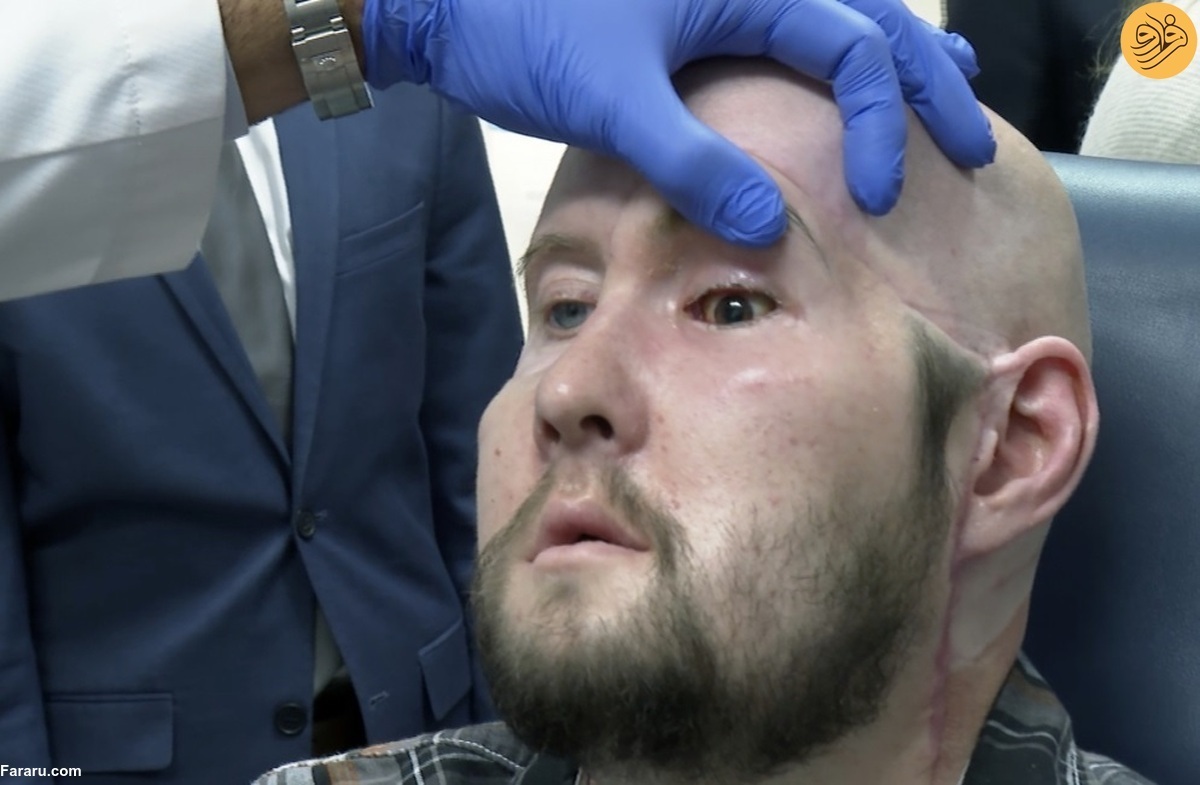 ویدیو | انجام نخستین پیوند چشم کامل انسان + جیمز 46 ساله کیست ؟