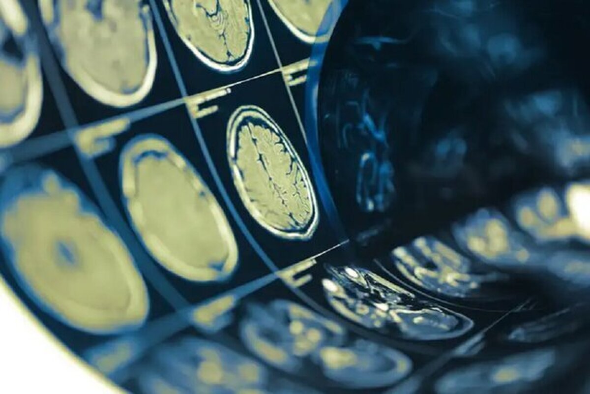 چرا مردان بیشتر با سکته مغزی می‌میرند؟