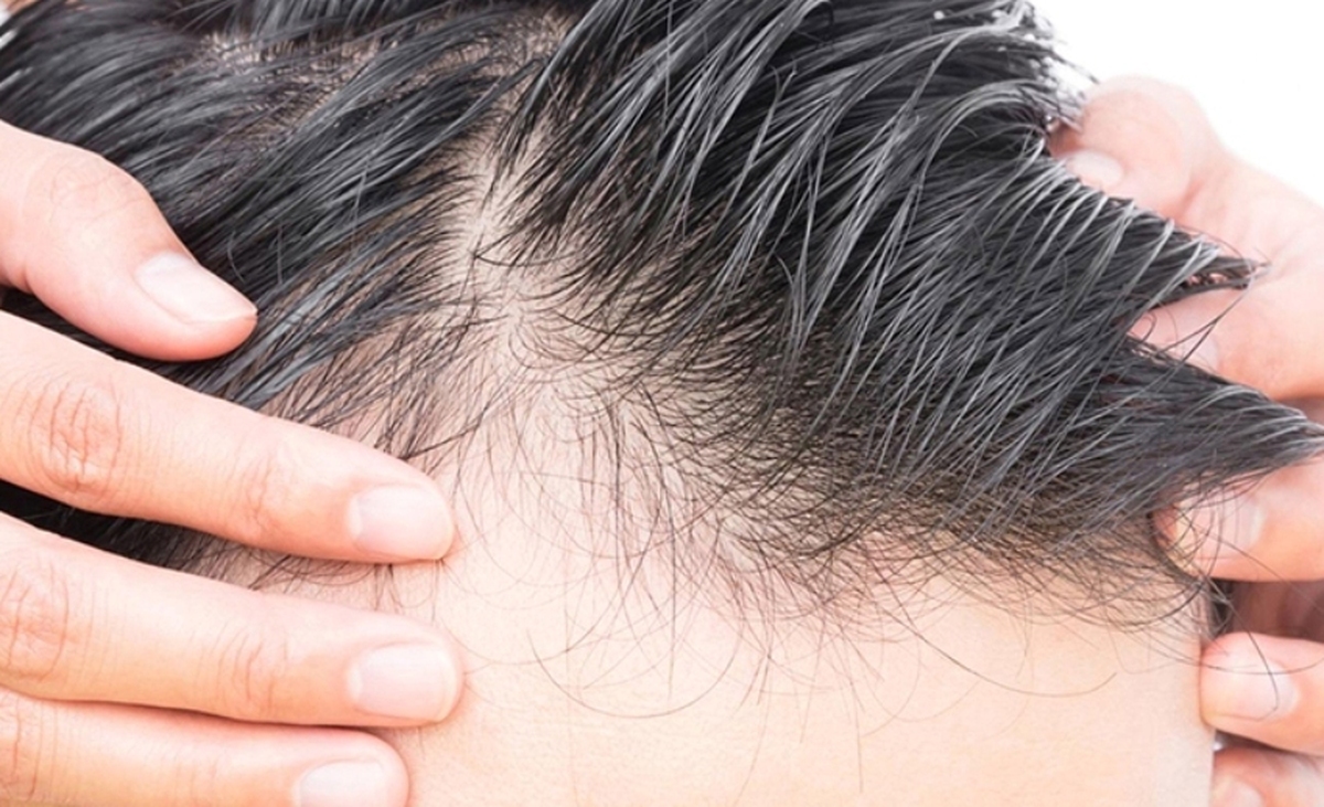روش‌های پیشگیرانه برای جلوگیری از ریزش مو