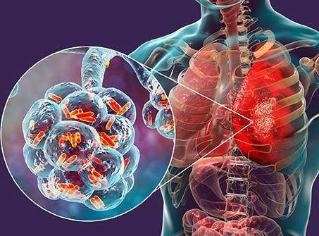 چرا در زمستان امسال بیشتر مریض می‌شوید؟ | این سه ویروس در کمین اند