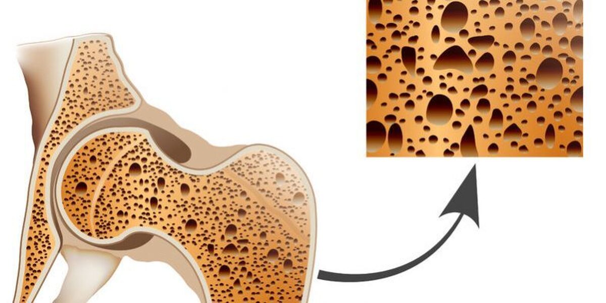 چند واقعیت عجیب در مورد پوکی‌استخوان