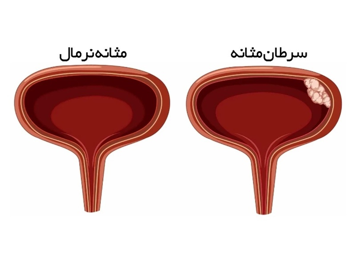 علائم سرطان مثانه را بشناسیم