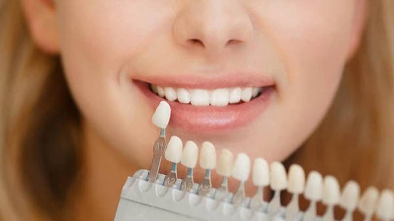 مزایا و معایب لمینت دندان از دیدگاه متخصص مزایا و معایب لمینت دندان از دیدگاه متخصص