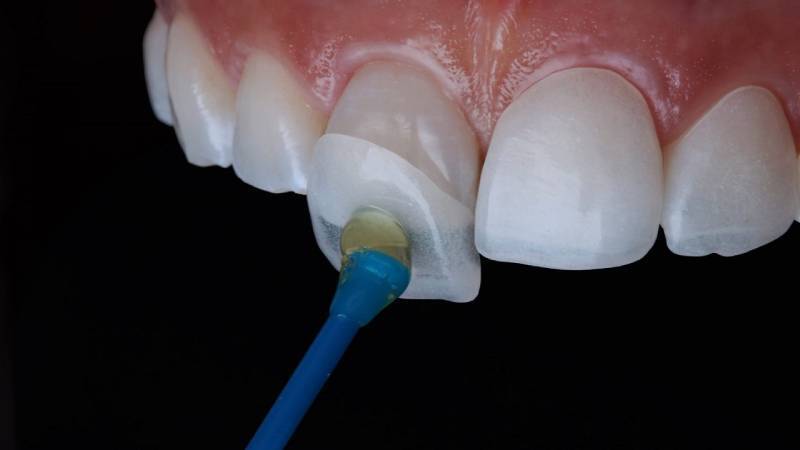 مزایا و معایب لمینت دندان از دیدگاه متخصص مزایا و معایب لمینت دندان از دیدگاه متخصص