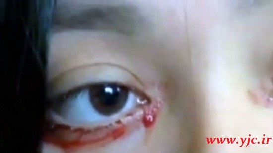 عکس | تصویری عجیب اما واقعی از دختری که خون گریه میکند! عکس | تصویری عجیب اما واقعی از دختری که خون گریه میکند!