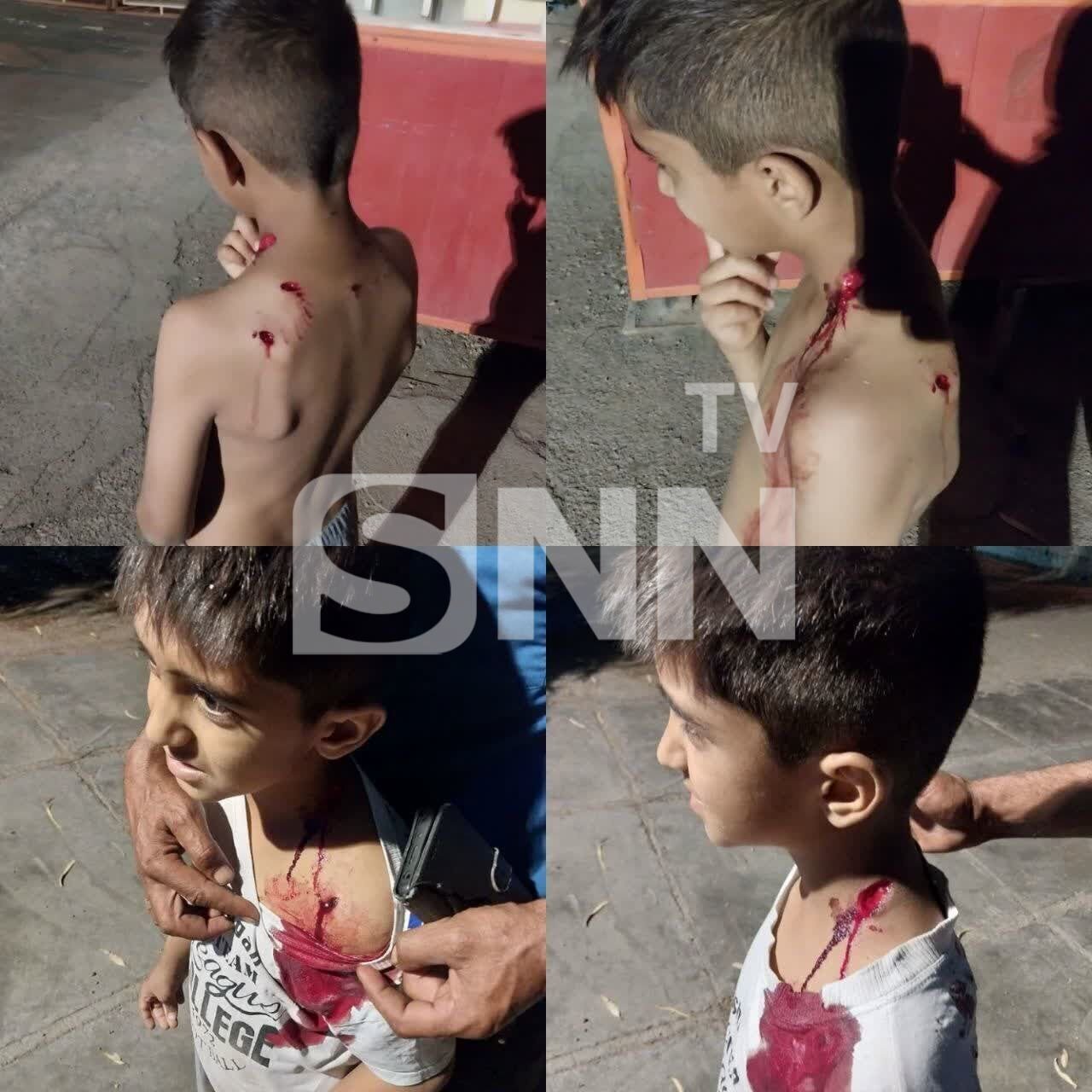 سگ ولگرد در این شهر حادثه آفرین شد | تصویر گازگرفتگی یک دانش آموز سگ ولگرد در این شهر حادثه آفرین شد | تصویر گازگرفتگی یک دانش آموز