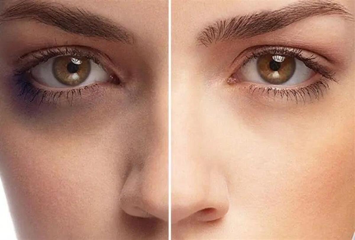 معجزه‌ای برای تیرگی دور چشم