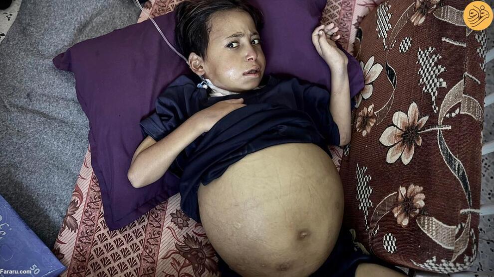 عکس | شکم غیرعادی و بزرگ کودک فلسطینی او را از پا انداخته!