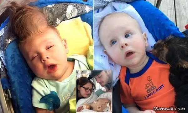 عکس | نوزادی که مغزش بیرون از سرش بود عمل شد! عکس | نوزادی که مغزش بیرون از سرش بود عمل شد!