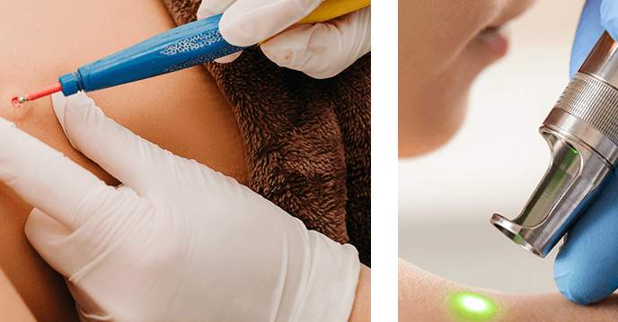 درمان زگیل تناسلی؛ بررسی هزینهها برای رهایی از HPV درمان زگیل تناسلی؛ بررسی هزینهها برای رهایی از HPV