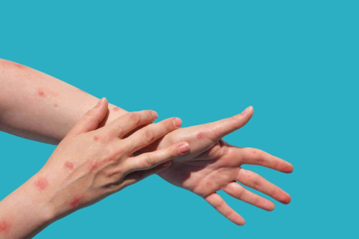 آبله میمون از افغانستان وارد ایران شد؟