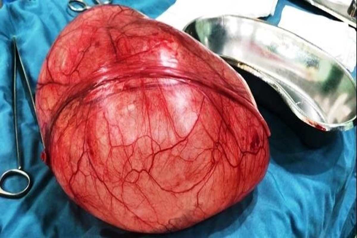 عکس | کیست ۶ کیلویی از شکم بیمار در بندرعباس خارج شد! عکس | کیست ۶ کیلویی از شکم بیمار در بندرعباس خارج شد!