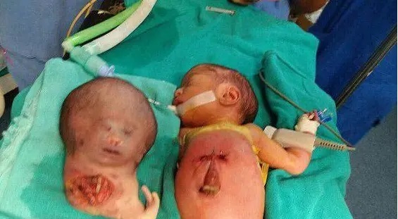 عکس | نوزاد دو سر جراحی شد! | این عکس را نبینید بهتر است!