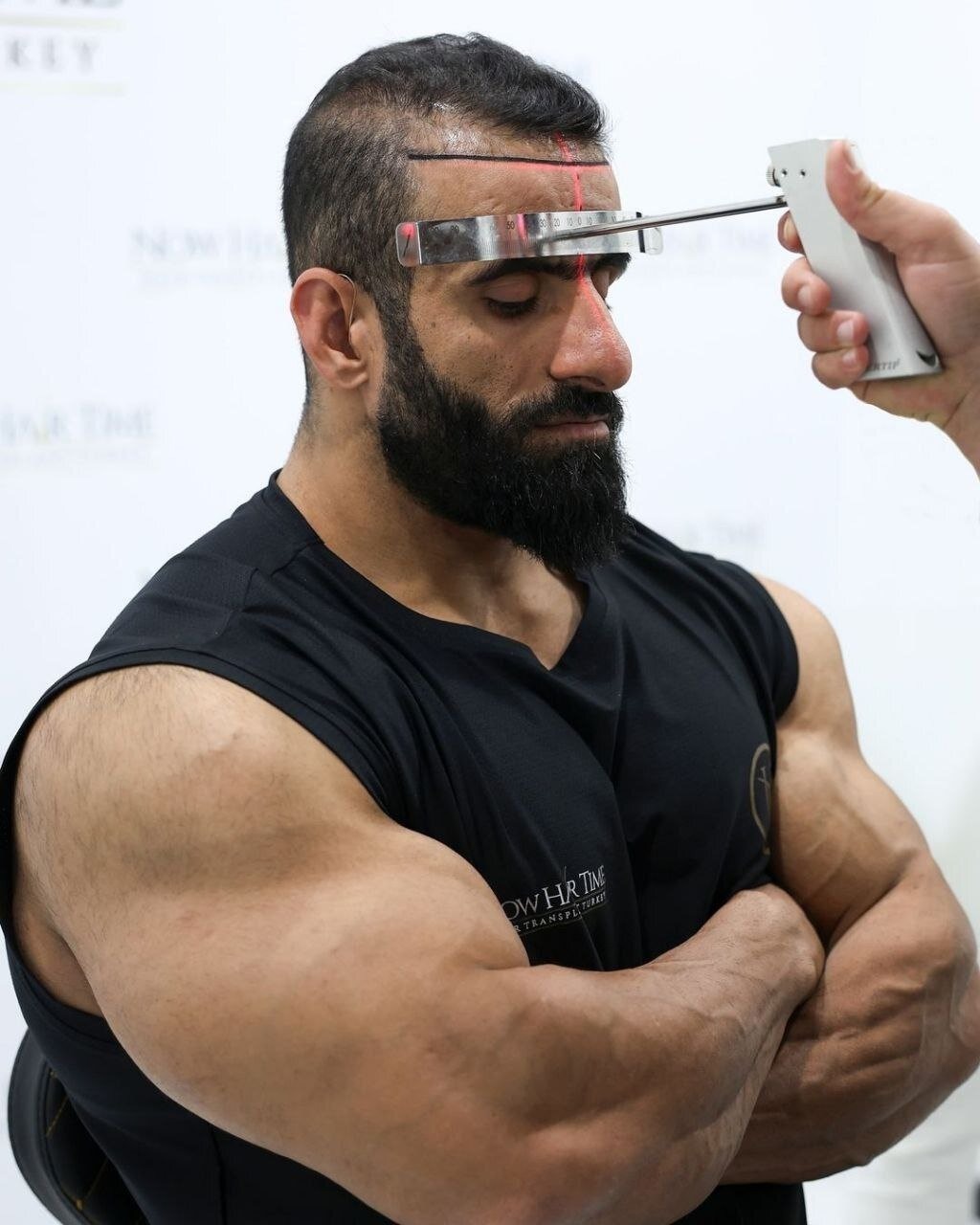 عکس | هادی چوپان در حال کاشت مو در ترکیه! عکس | هادی چوپان در حال کاشت مو در ترکیه!