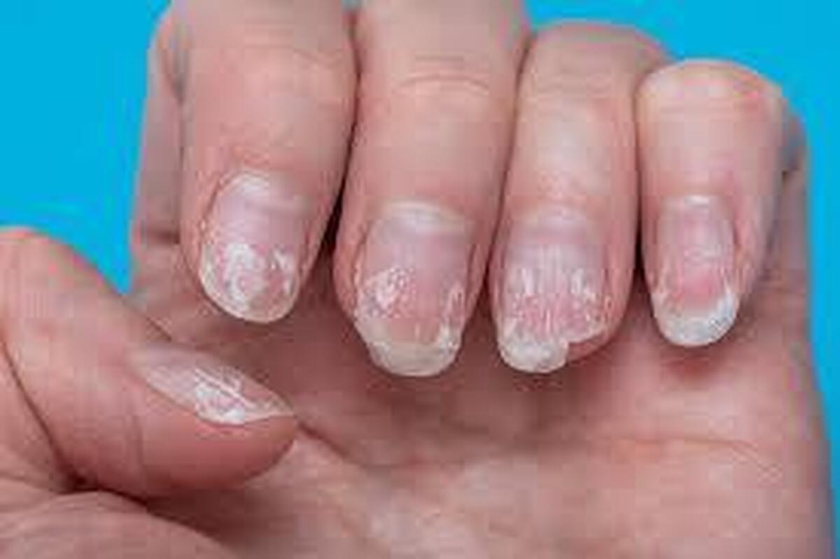 راه‌های کنترل پسوریازیس ناخن چیست ؟