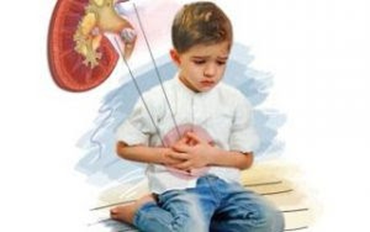 علائم مختلف سنگ‌کلیه در کودکان | یک باور غلط درباره ایجاد سنگ‌کلیه
