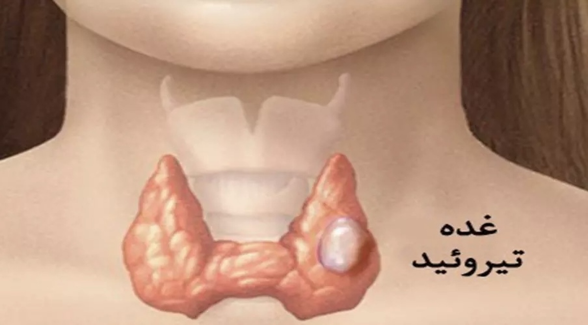 روش‌های درمانی برای کمک به حفظ سلامت تیروئید
