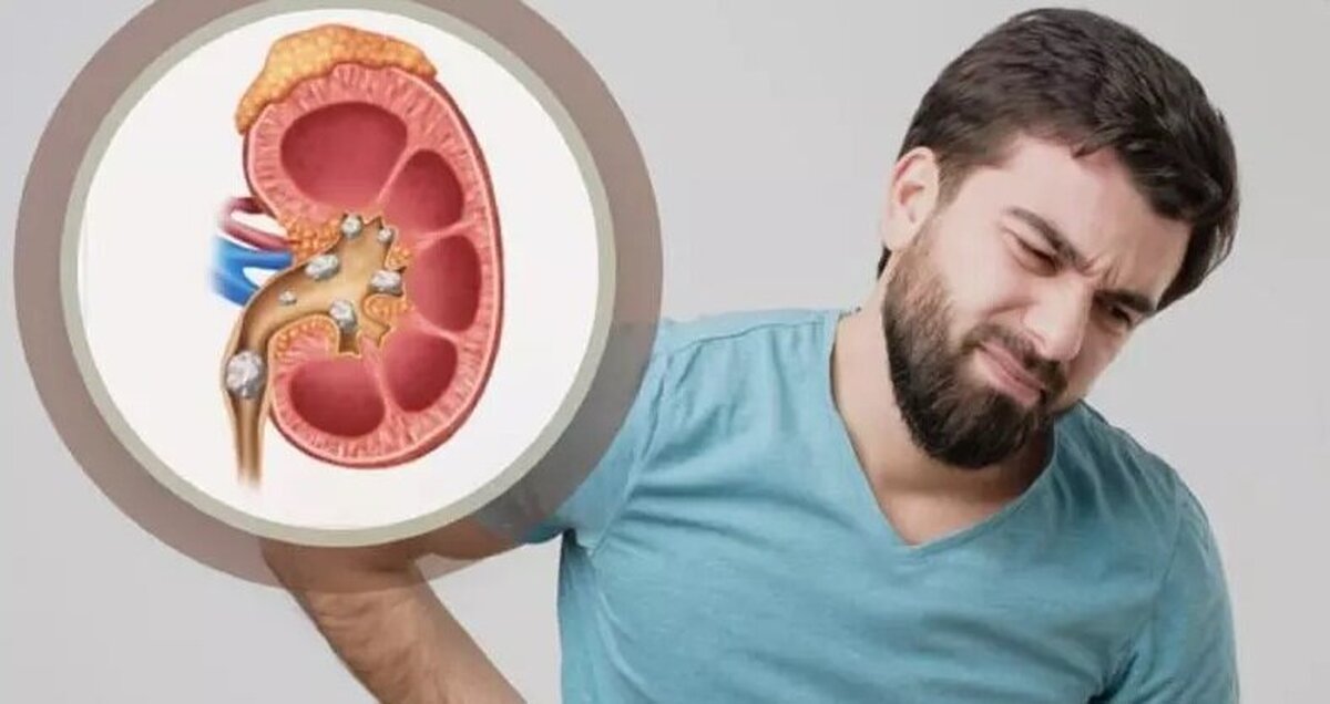 اگر سنگ کلیه دارید این مکمل را نخورید