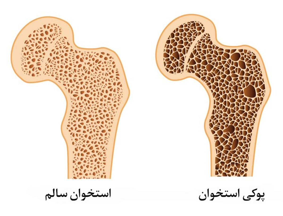حفظ تراکم استخوان‌ها با خوردن این مواد معدنی