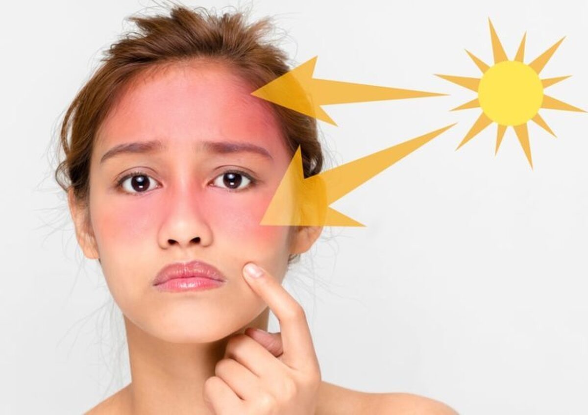 برای درمان آفتاب‌سوختگی چه دارویی بخریم ؟