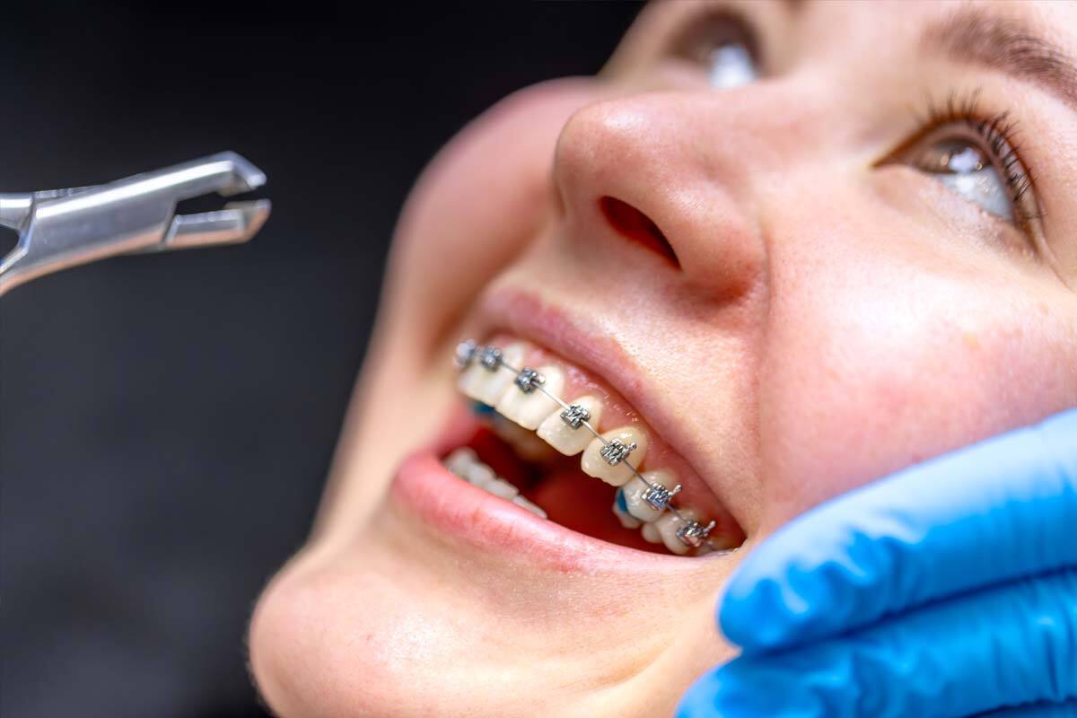 چه زمانی نیاز به ارتودنسی داریم ؟ نشانه‌هایی که نباید نادیده بگیرید